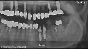 Immediate implantation using I...