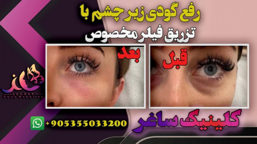 تزریق فیلر زیر چشم