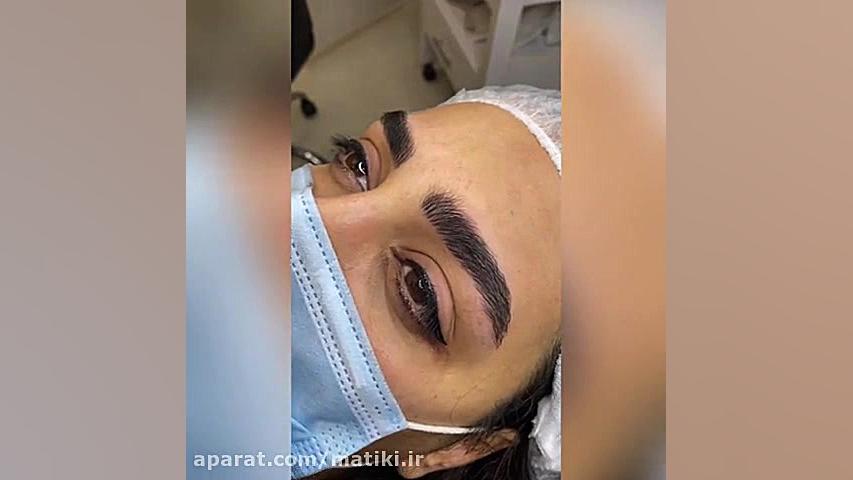 میکروبلیدینگ و میکروپیگمنتیشن...