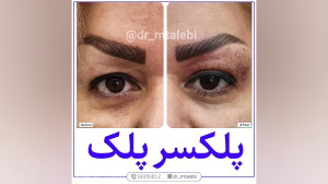 معجزه ی پلکسر