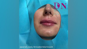 فیلم کامل تزریق 1 سیسی ژل لب