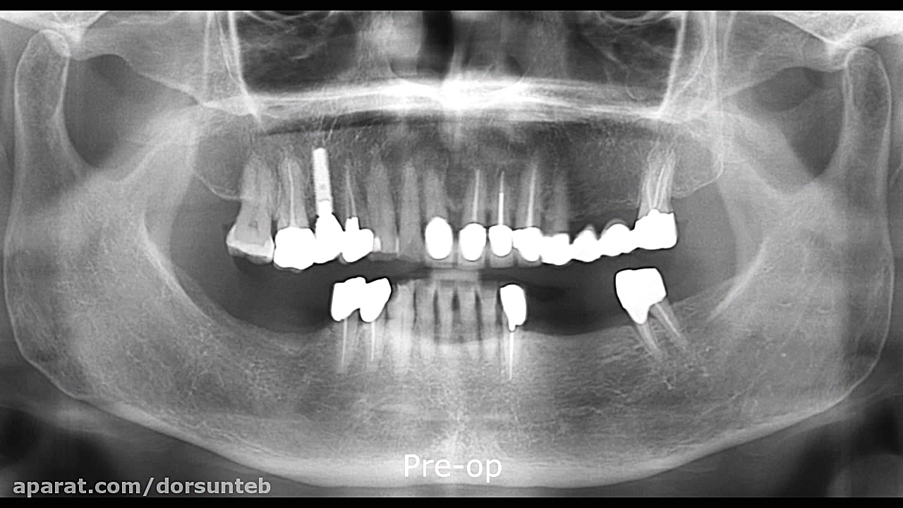 HA Collagen membrane