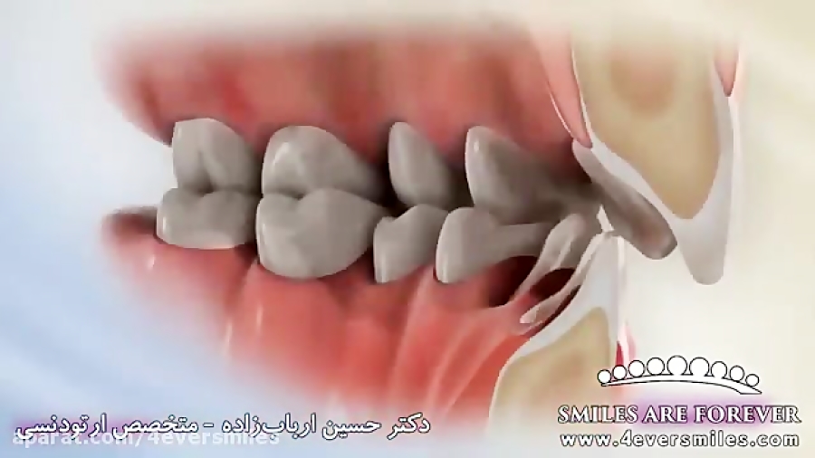 ارتودنسی همپوشانی دندان ها (دی...