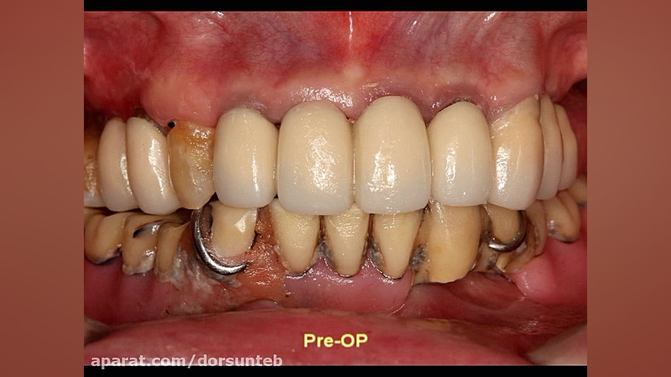 Slim Onebody  Mini implants fo...