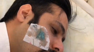 آموزش کرایوتراپی زگیل تناسلی و...