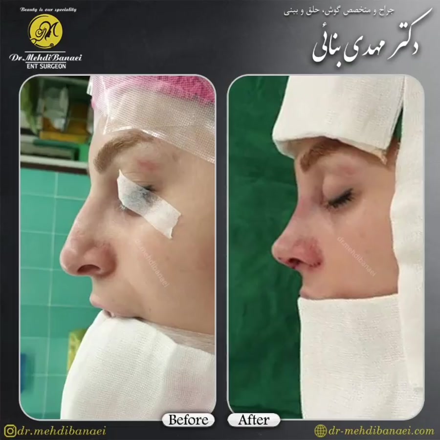 عمل زیبایی بینی و رفع افتادگی نوک آن