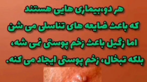 درمان قطعی زگیل تناسلی ؟؟!!