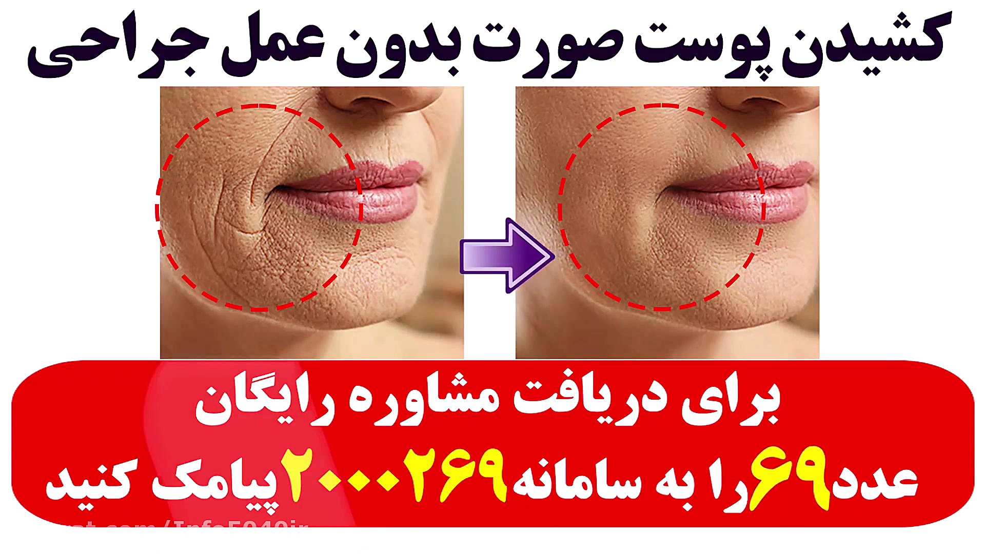 کشیدن پوست صورت بدون بوتاکس و...