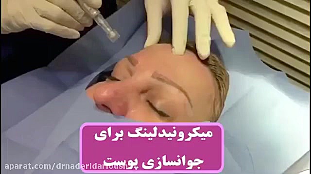 فیلم کامل میکرونیدلینگ صورت
