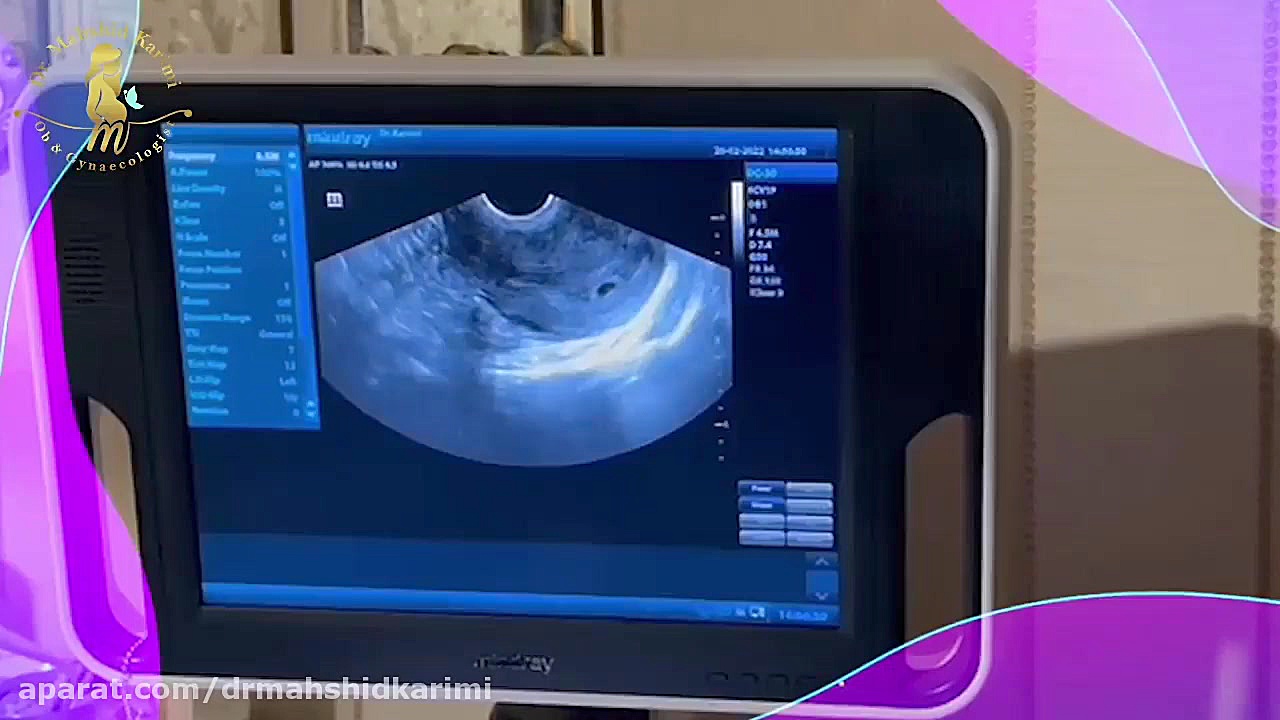 بارداری موفق با آی یو آی با او...