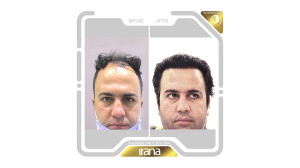 نمونه قبل و بعد کاشت مو