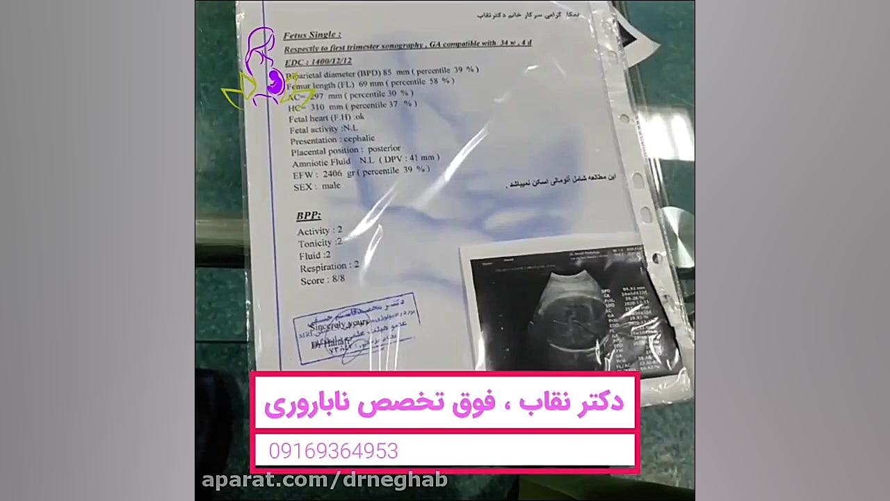 بارداری حاصل ivfدر خانمی با تخ...