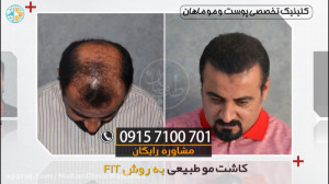 کاشت مو به صورت اقساط و بالاتر...