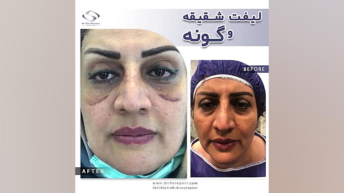 فیلم واقعی و بدون سانسور لیفت...