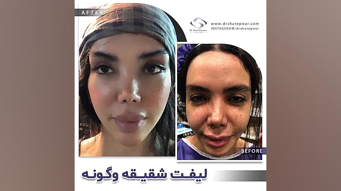 فیلم واقعی و بدون سانسور لیفت...