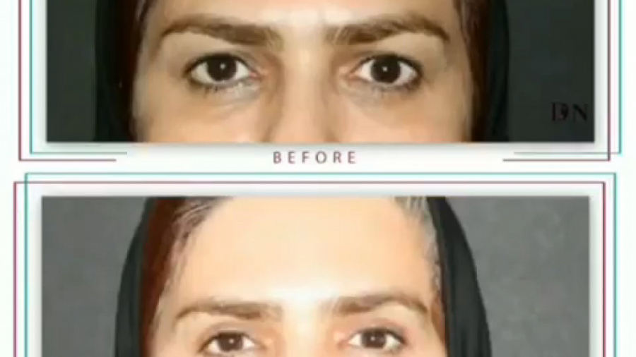 فیلم واقعی جراحی پلک