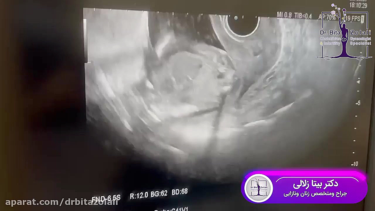 فیلم سونوگرافی جنین پسر