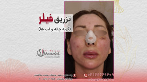 فیلم واقعی تزریق فیلر گونه، چا...