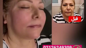 فیلم قبل و بعد تزریق فیلر به ک...