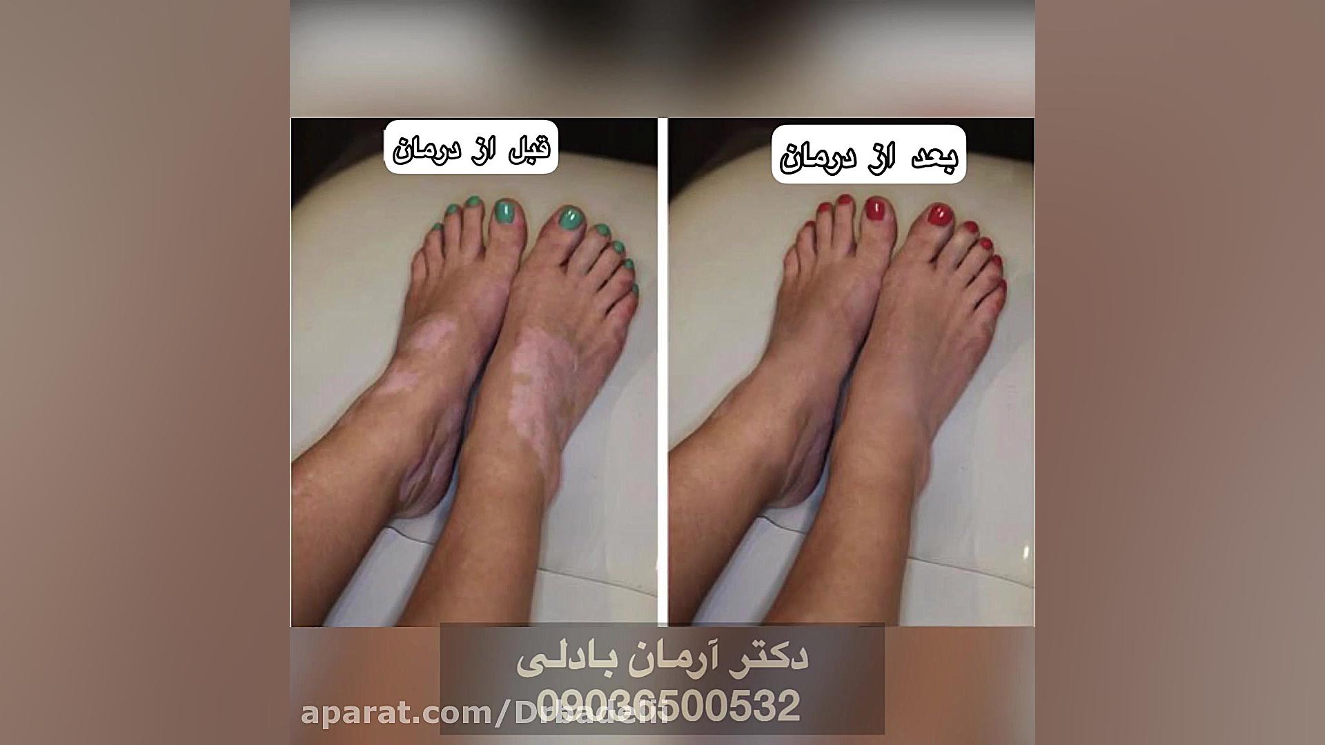 درمان قطعی بیماری پیسی کشف شد!