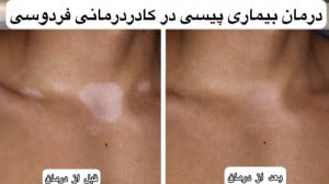 درمان ۱۰۰٪ بیماری پیسی با ضمان...