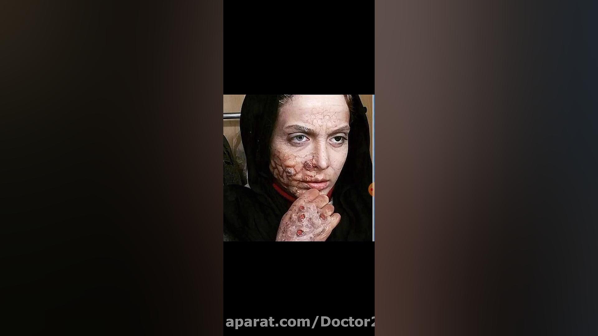 درمورد مریضیه آبله میمون یا هم...