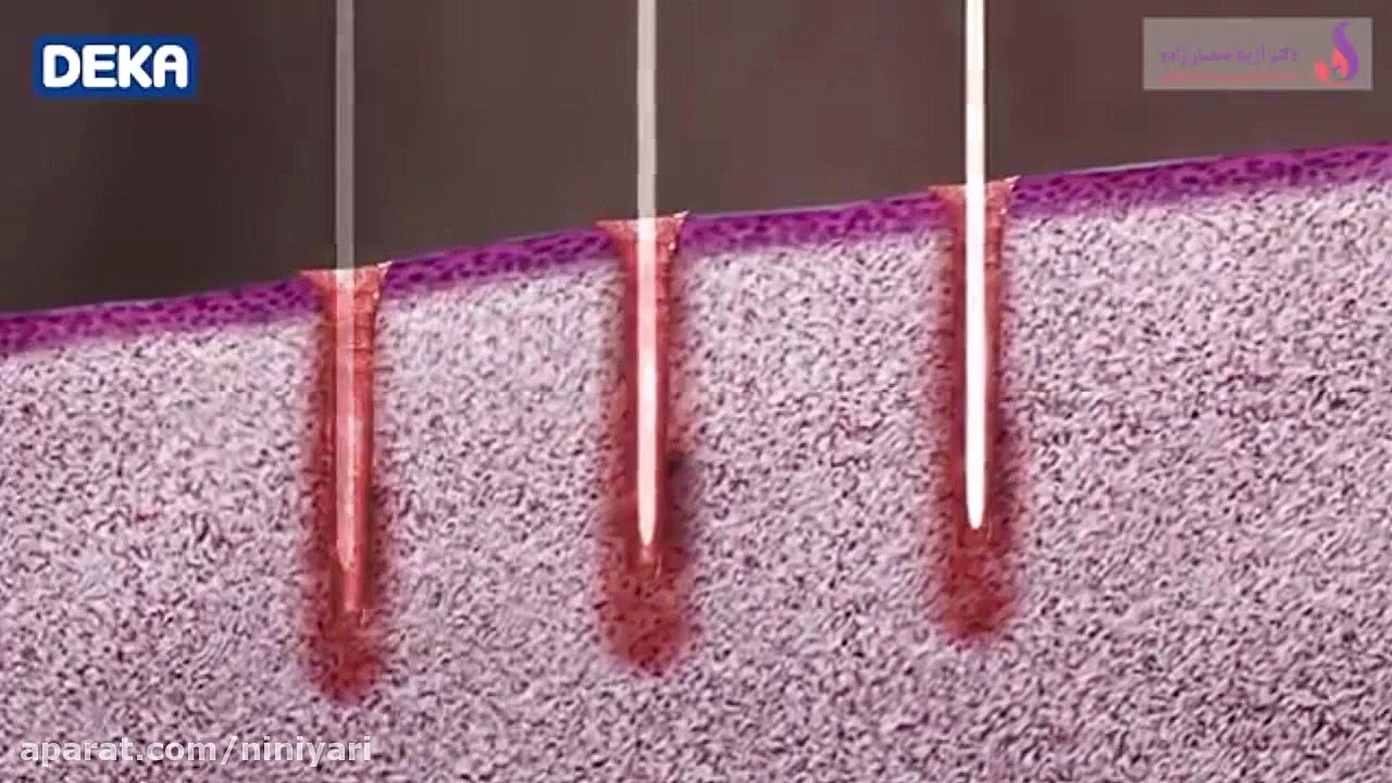 انیمیشن جراحی و جوانسازی ناحیه...