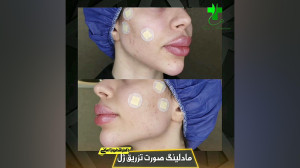 مادلینگ صورت تزریق ژل