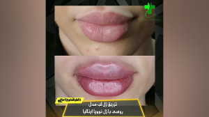 تزریق ژل لب مدل روسی