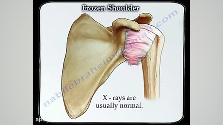 شانه منجمد (یخ زده) چیست و چگو...