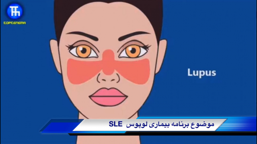 بیماری لوپوس چیست و چه شرایطی...