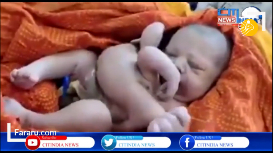 تولد عجیب ترین نوزاد انسان با...