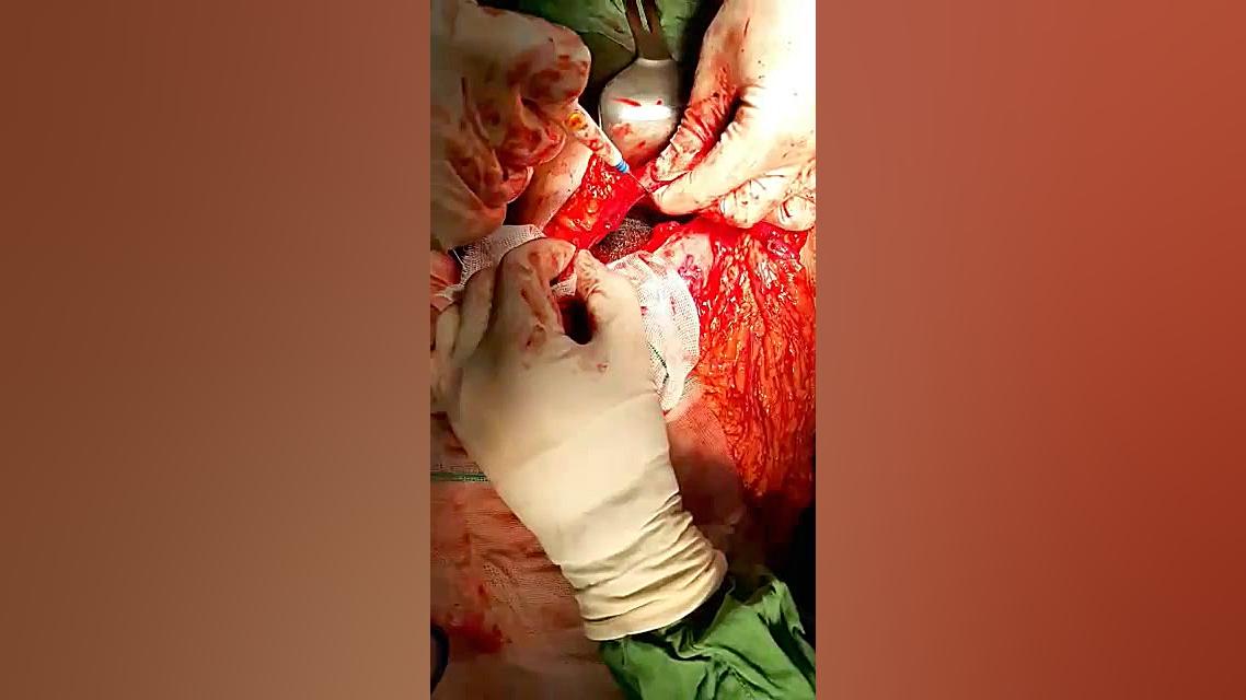 عمل جراحی زنی که چند سال عادت...