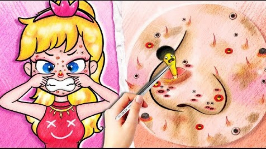 ایده های کارتونی  آکنه های سیا...