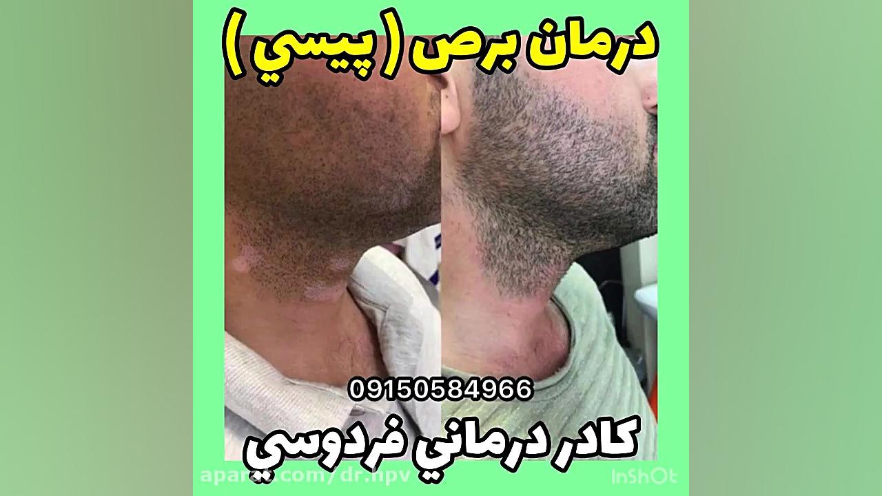 درمان گیاهی لک پیسی