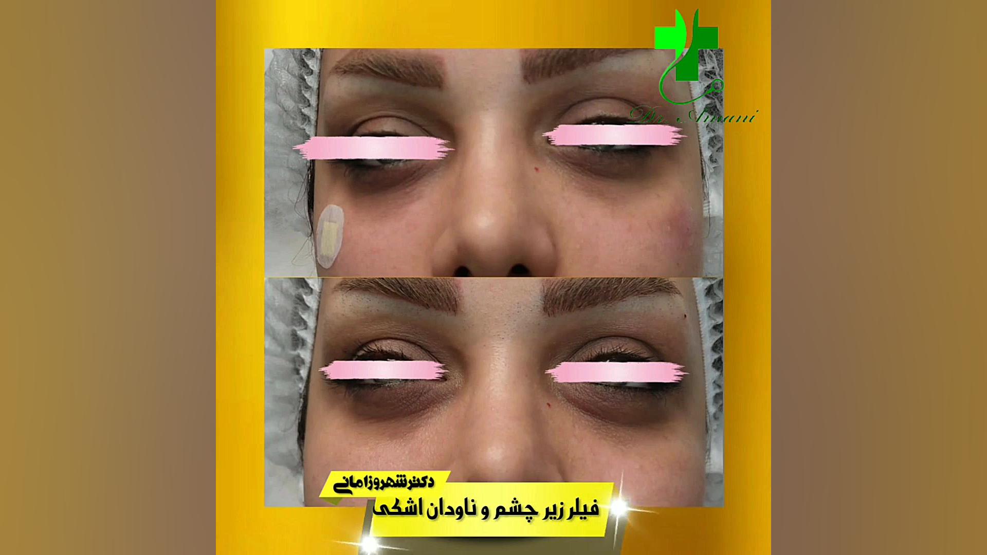 فیلر زیر چشم دکتر شهروز امانی