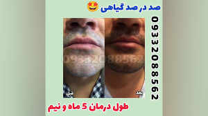 درمان برص در مردان