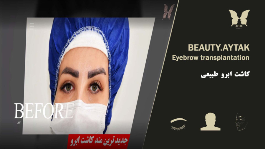 فیلم پیوند ابرو طبیعی | مرکز ک...