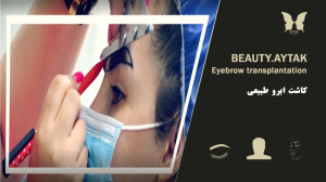 فیلم پیوند ابرو طبیعی | مرکز ک...