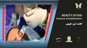 فیلم پیوند ابرو طبیعی | مرکز ک...