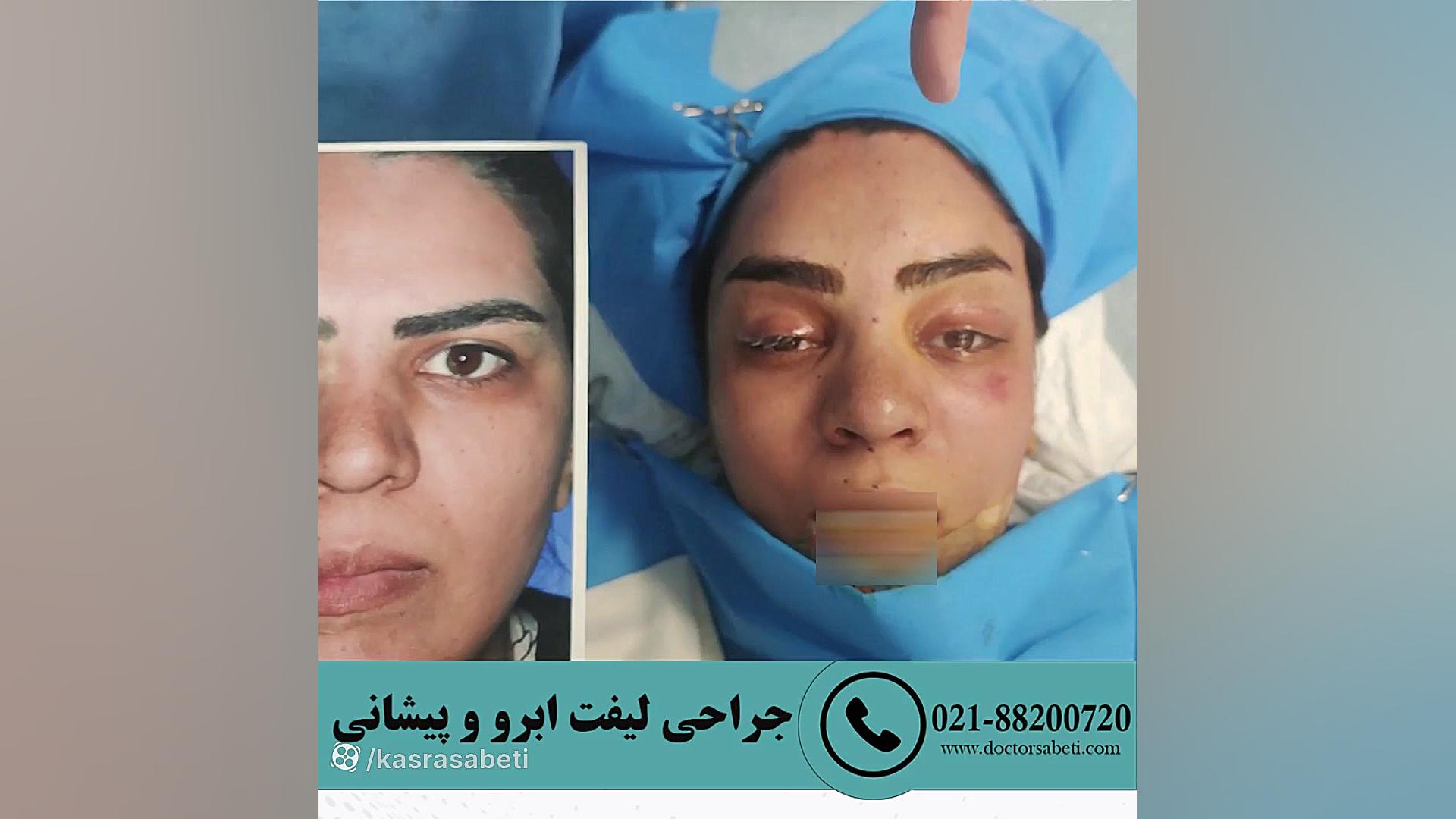 جراحی لیفت ابرو و پیشانی دکتر...