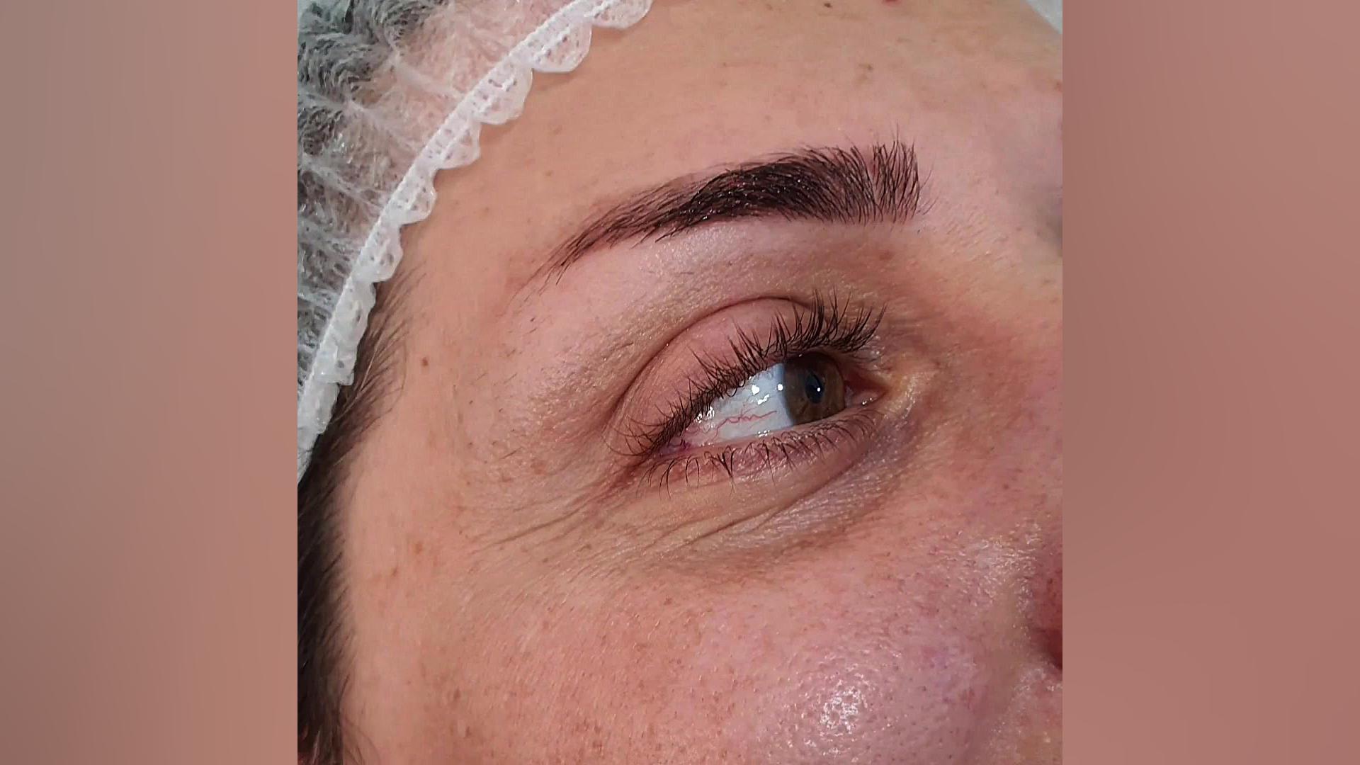 قبل از انجام میکروبلیدینگ