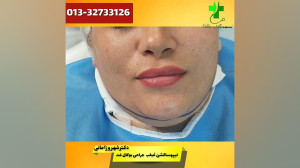 لیپوساکشن غبغب دکترشهروز امانی...