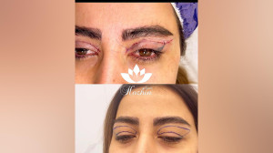بلفارو پلاستی کلینیک هوژین