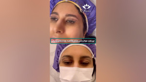 بلفاروپلاستی کلینیک هوژین