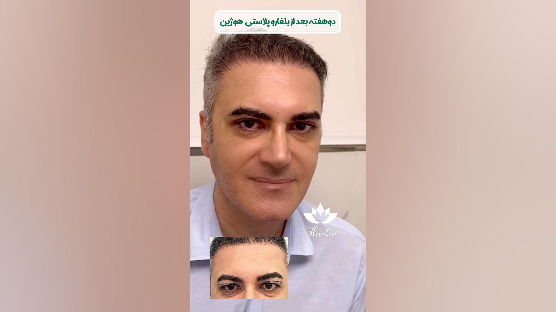 بلفاروپلاستی اقایان