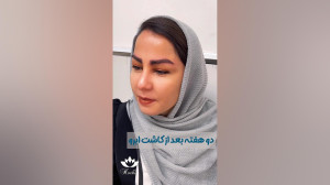 دو هفته بعد از کاشت ابرو