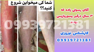 پسوریازیس و درمان آن