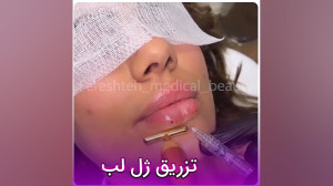 تزریق ژل لب