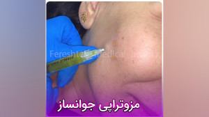 مزوتراپی جوانساز